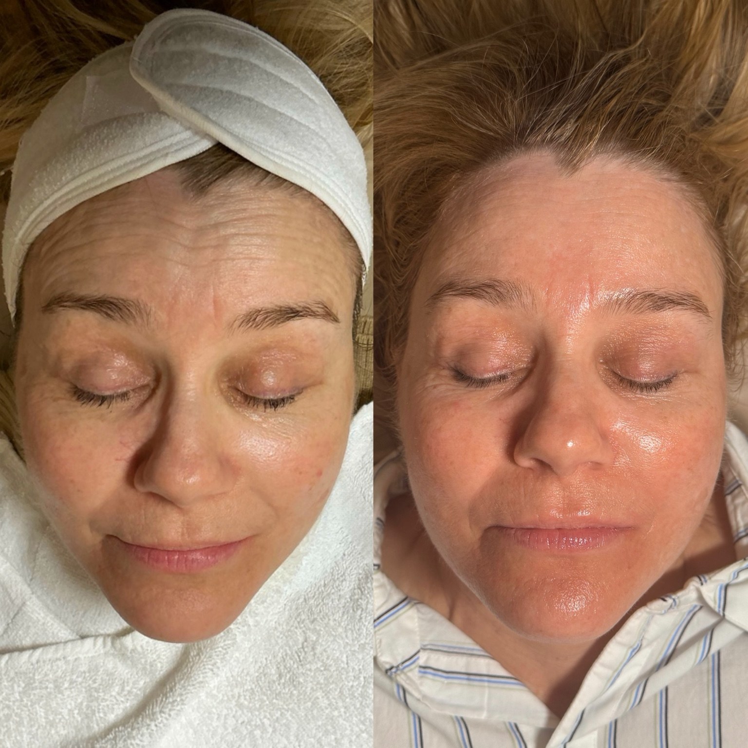 Side by side close up photographs of a client before and after a facial treatment